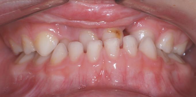 zubního oblouku v průměru menší neţ u zdravých jedinců, proto se i v dočasném chrupu často setkáváme v laterálním úseku se zkříţeným skusem [121]. A B Obr.