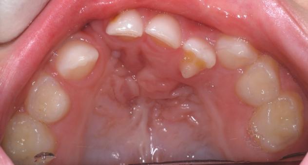 Z ortodontických anomálií nalézáme agenezi 52, obrácený skus v rozsahu 53-62 a anomální tvar 62 (archiv Oddělení ortodoncie a rozštěpových vad FNKV).