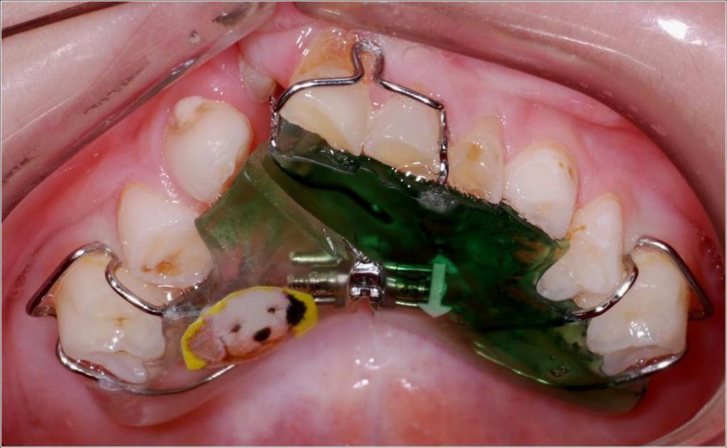 Bylo prokázáno, ţe zákus horních frontálních zubů a zkříţený skus mají další negativní vliv na další vývoj horní čelisti rozštěpového pacienta a tendenci se během růstu zhoršovat, proto je výhodné