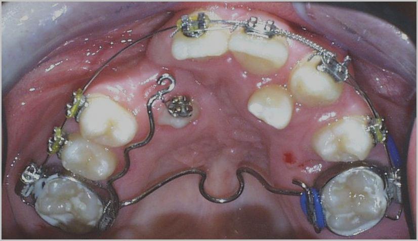 zubů, jejichţ poloha a postavení můţe negativně ovlivnit výsledek spongioplastiky. Většinou se jedná o laterální řezák, nadpočetný zub, nebo dens praecaninus.