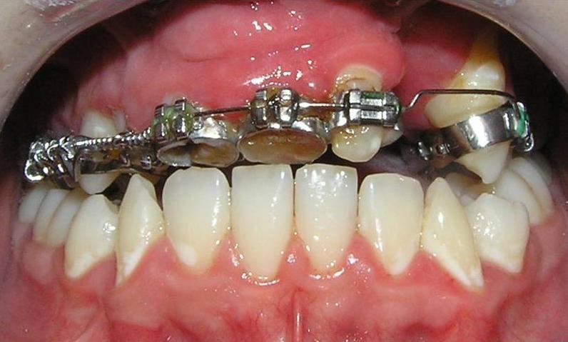 V této fázi léčby vyuţíváme fixní ortodontické aparáty v kombinaci s individuálně zhotovenými patrovými oblouky, které zajišťují ortodontický tah pro zařazení retinovaných zubů (obr. 35).