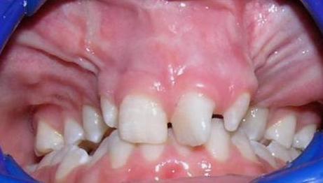 v bezprostředním okolí rozštěpové štěrbiny, proto na ně nelze aplikovat ortodontické zámky fixované pomocí adheziv přímo na sklovinu vestibulární plochy zubu.