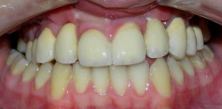 Po dokončení erupce stálého chrupu je nutné řešit defekt dentice přibliţně u poloviny pacientů s rozštěpem, častěji v případech, kde rozštěpová vada zasahuje i alveolární výběţek.