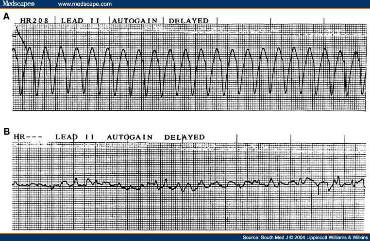 VF/ VT