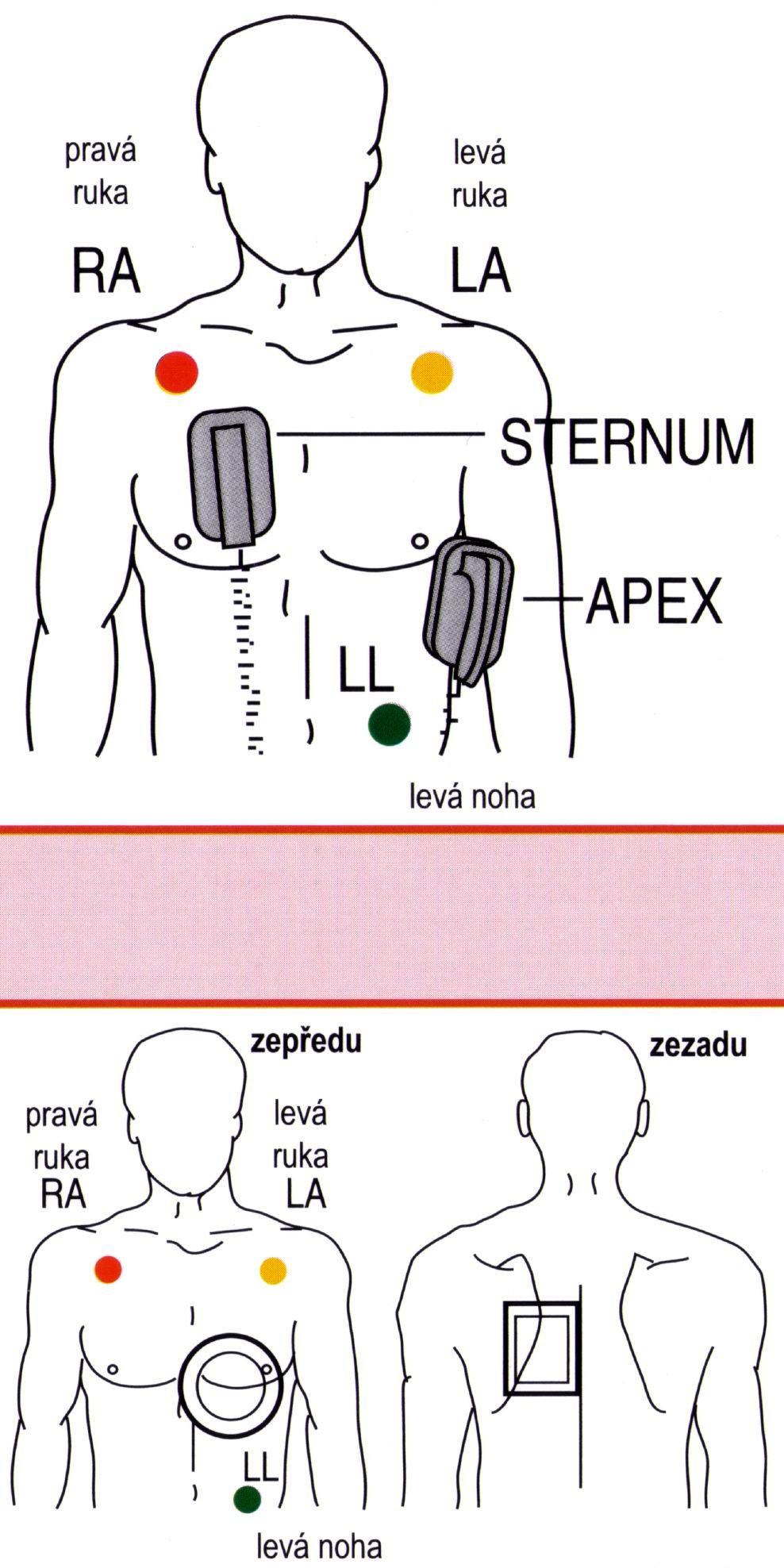 Defibrilace je metodou volby u KT a KF má přednost před dalšími postupy (adrenalin, OTI) KF je zrušena