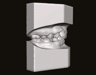 4A 4B 4C 4D 4E Obr. č. 4A-E : Počáteční digitální modely/initial digital models. Plán léčby Pacientka od léčby očekávala především úpravu dásňového úsměvu a vyrovnání frontálních zubů.