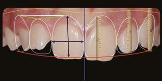 5A 5B Obr. č. 5A-D: Plánování úsměvu pomocí DSD Digital Smile Design/ DSD Digital Smile Design planning. 5C 5D Postup léčby Sekvence oblouků v horním zubním oblouku:.