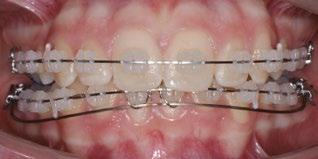 individualizovaný tvar oblouku (5 měsíců) Nákusy na horních laterálních zubech byly