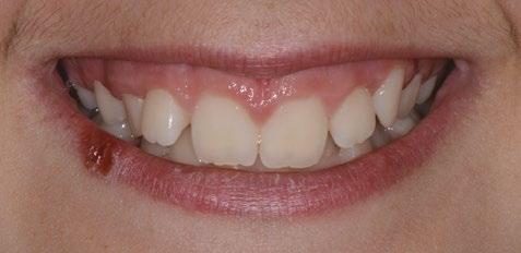 Podrobné informace získané díky ortodontickému plánování Digital Smile Design byly velkým přínosem pro dosažení výsledného stavu.