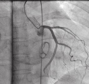 Comparable VARC-2 device failure composite endpoint with ACURATE neo versus