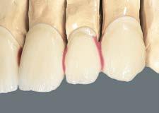 Před prvním dentinovým pálením se u můstku musí separovat jeho jednotlivé členy, a sice vždy interdentálně až na konstrukci. Hotová práce pro první dentinové pálení.