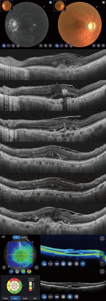 vzácněji, diabetes. Glaukom: 51 let, muž, OD Glaukom je onemocnění, které poškozuje optický nerv.