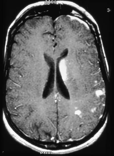 meningitidis = meningokok) viry