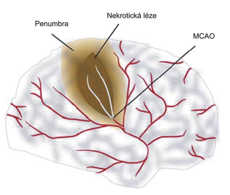 Obr. 5 Fokální ischemie (Mitsios, Gaffney et al. 2006) Okluze střední mozkové artérie (MCAO) vede ke vzniku nekrotické léze v přilehlé tkáni.