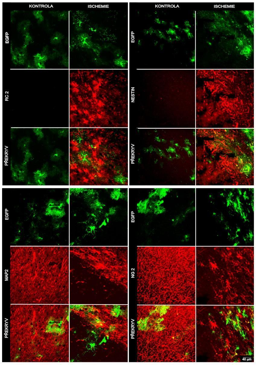 Obr. 20 Imunohistochemické změny v mozkové kůře na rozhraní léze po MCAO Na rozhraní ischemické léze se začne exprimovat RC2 (vlevo nahoře) a nestin (vpravo nahoře).