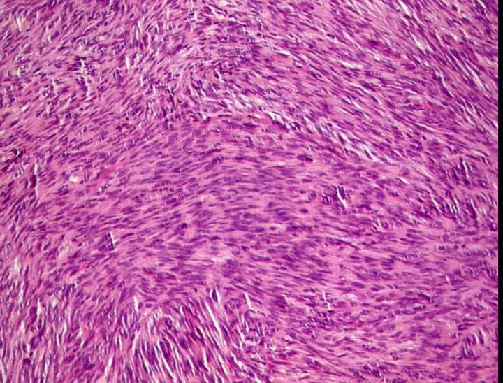 při významném down stagingu Histologie: Nádor složený z řídce uložených vřetenitých buněk bez