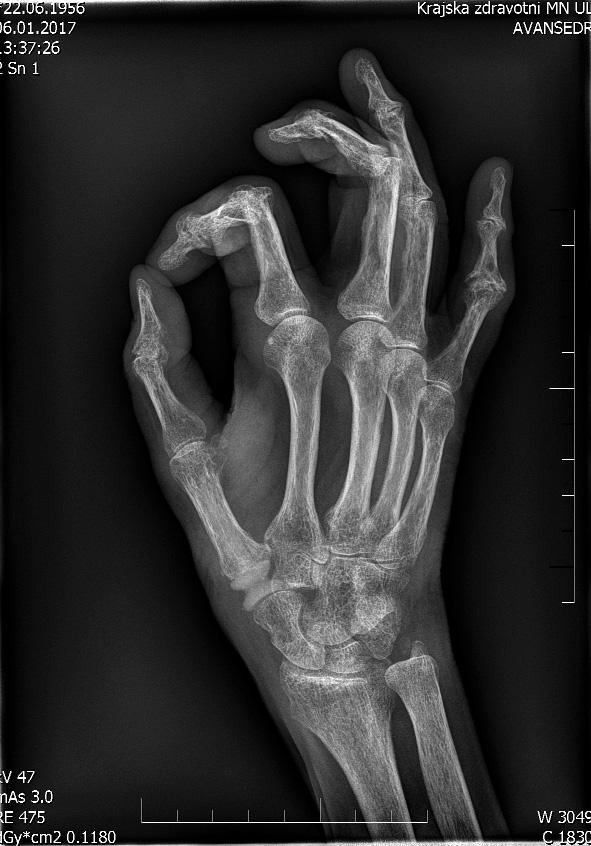 Interpoziční a závěsné artroplastika kořenového kloubu pálce ruky implantátem TIE-IN, šlachová klička FCR okolo implantátu. pollicis longus ke kloubnímu pouzdru.