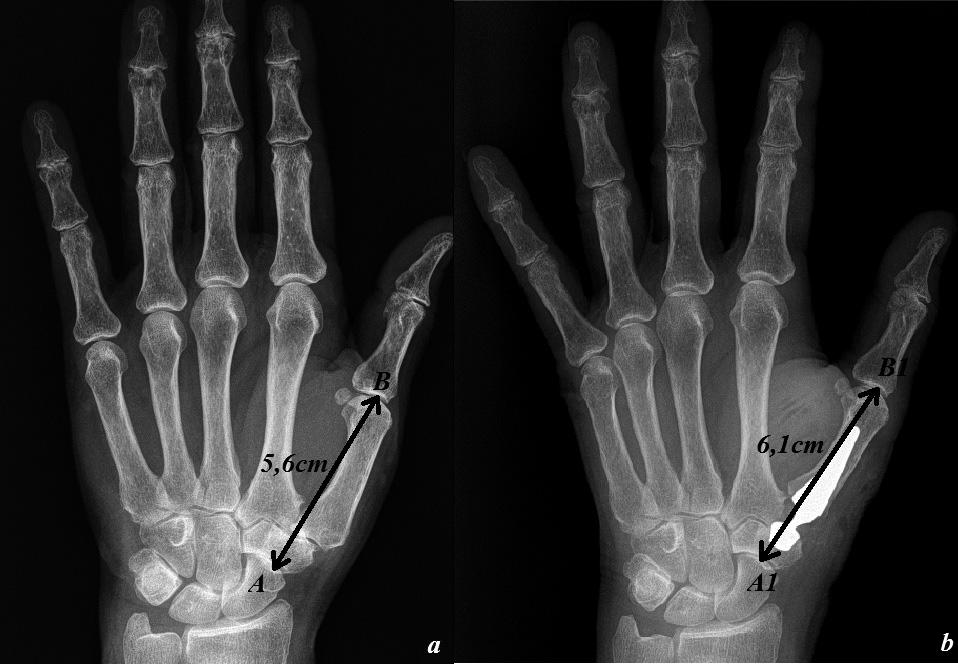 131/ Acta Chir Orthop Traumatol Cech. 85, 2018, No. 2 PŮVODNÍ PRÁCE ÚVOD Rhizartróza je degenerativní postižení karpometakarpálního (CMC) kloubu palce ruky.