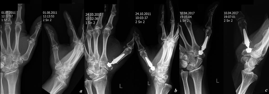 132/ Acta Chir Orthop Traumatol Cech. 85, 2018, No. 2 PŮVODNÍ PRÁCE Obr. 2. Předoperační (a) a pooperační rtg snímky po 6 týdnech (b) a po 5 letech od operace (c) v předozadní a boční projekci u stejné pacientky.