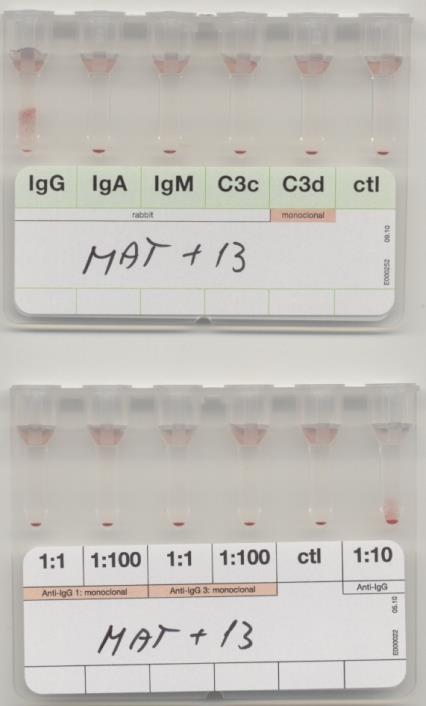 Naadsorbovaný PAT Dárcovské ery (antigenní shoda s pacientkou) Navázání protilátky Určení typu
