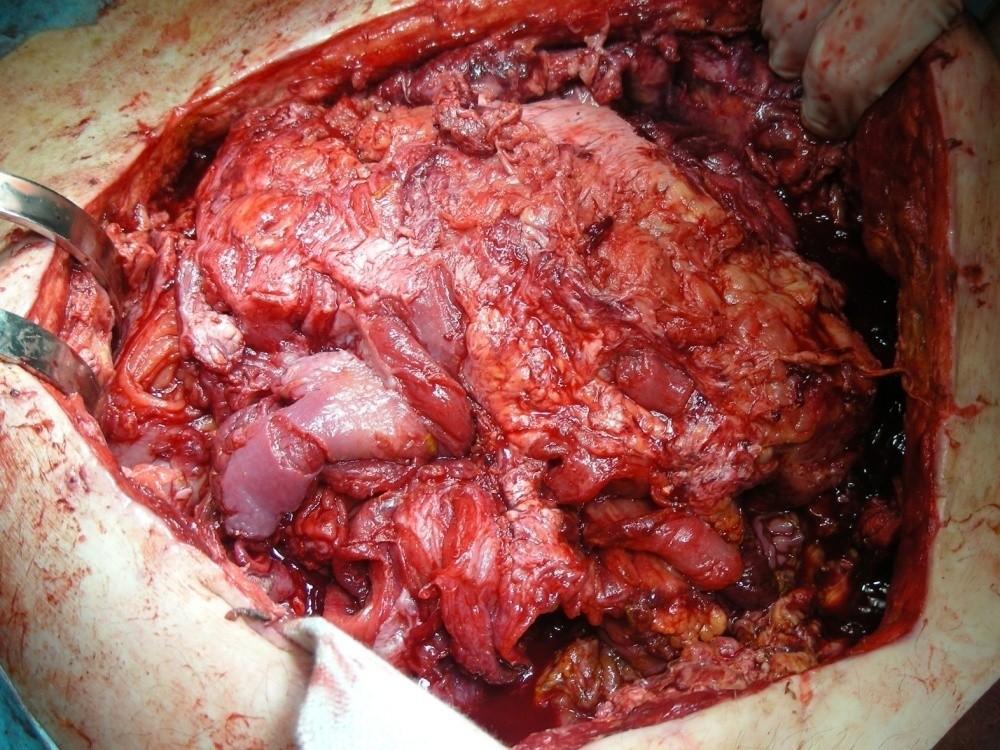 4.2.2008 -peroperační cystoskopie + sondage ureterů -objemný zapáchající absces MP s corpus alienum do kterého vrostlé