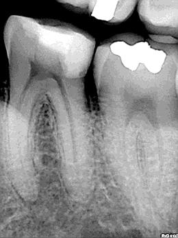 Před zákrokem Mikroskopický snímek (x12) 3 meziálních kanálků po instrumentaci