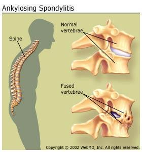 ankylosing spondylitis - poločas 3.