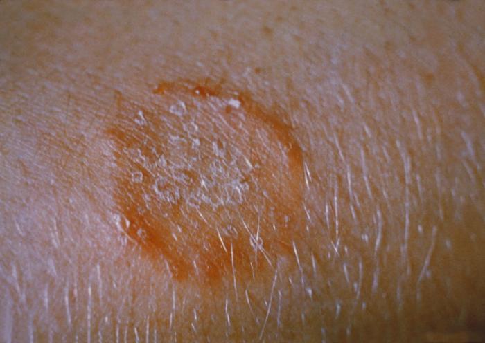 Radiační toxicita IV. Tinea capitis (Ringworm) plísňová infekce - zač. 20.st.