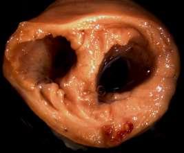 Hart Failure in 24th week after fistula ACF CTRL AVF