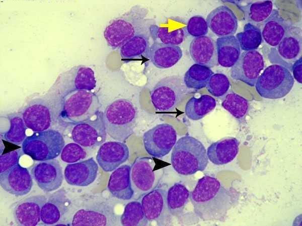 Waldenström macroglobulinemia (WM) lymphoplasmacytic lymphoma with immunoglobulin M (IgM) monoclonal protein Diagnosis 10% clonal lymphoplasmacytic cells presence of monoclonal