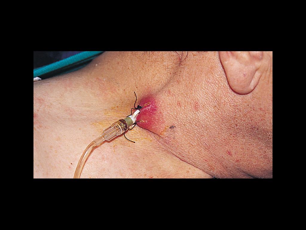 Catheter exit site infection in a patient with