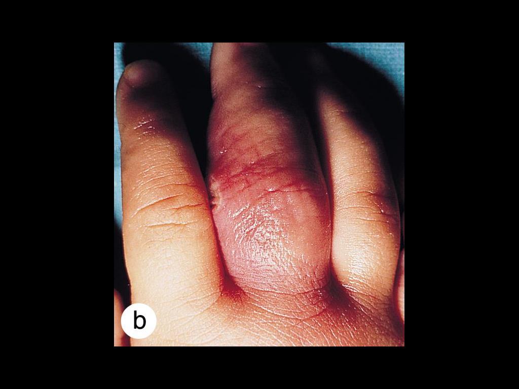 Primary cutaneous nocardial infection is characteristically painless, localized and slowly progressive.
