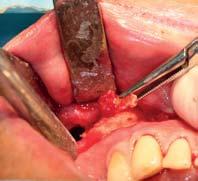 Dentoalveolární chirurgie Při výkonech dentoalveolární chirurgie používáme koncovky osteoplastické, jejichž pomocí lze šetrně odpreparovat kostní tkáň nad retinovanými zuby ať v případě jejich