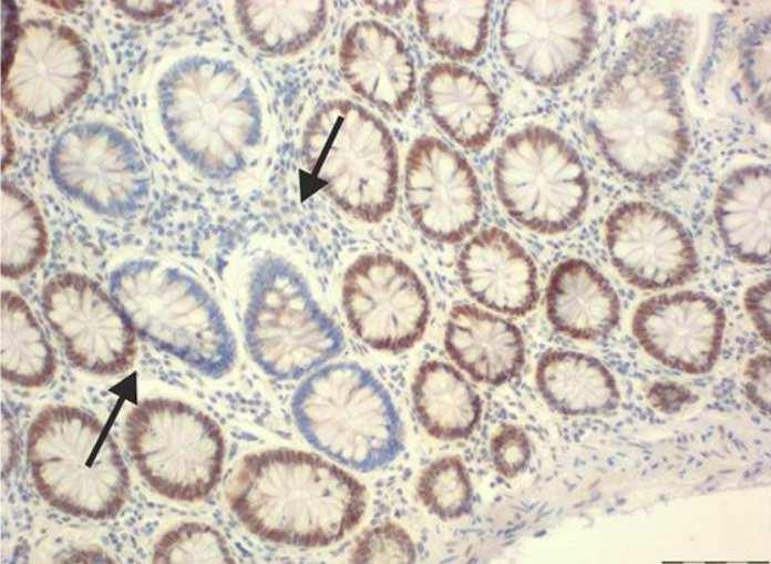 Lynchův syndrom Typ polypů: vilózní, často HG dysplázie Ojediněle i serrated léze