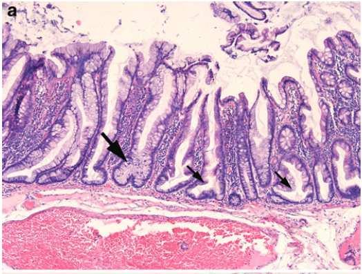 Serrated polyposis syndrome Dědičnost:?