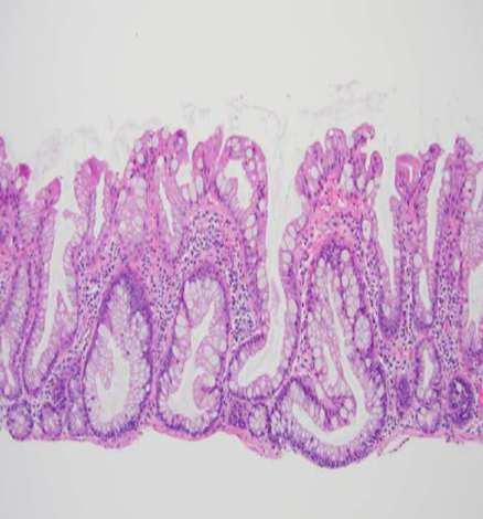 Serrated polyposis syndrome Typ polypů: serrated léze jakéhokoliv typu Typický