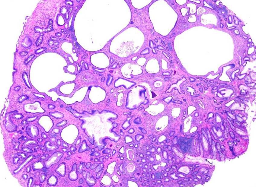 Juvenile polyposis syndrome Typ polypů: juvenilní Typický počet polypů: 5 500 (do 2 juvenilních