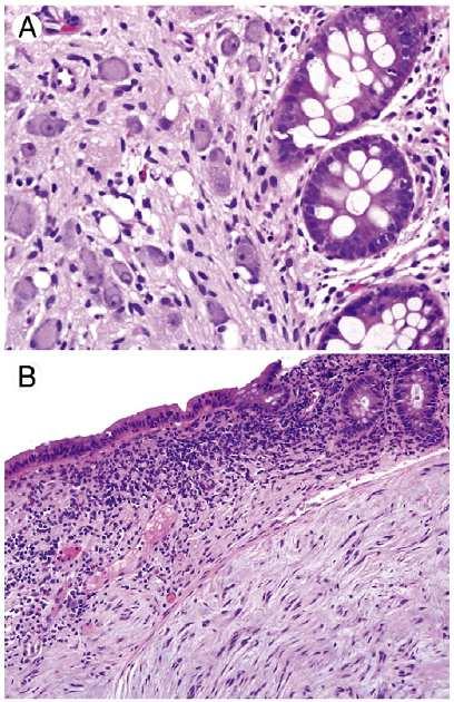 PTEN hamartomatous tumor syndrome Celoživotní riziko vzniku malignity: až 85% Vrchol incidence malignit:?