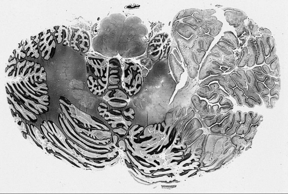 PTEN hamartomatous tumor syndrome Asociované léze: papilomy dutiny ústní, trichilemmomy, Lhermitte-Duclos