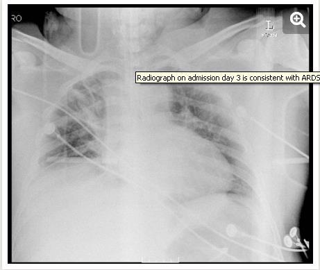 29-letý muž přijat na ICU pro respirační problémy po aspiraci krevní plyny a RTG snímek potvrzovaly dg ARDS pokračující zhoršování ventilačních parametrů nutná svalová relaxace vstupní teplota 38,4 C