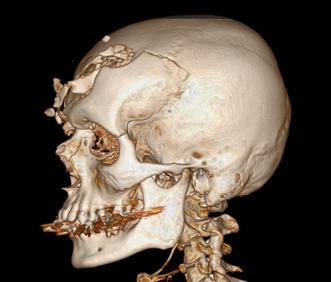 Kazuistika DG Edém mozku, pneuocefalus, SAK difusně více vlevo, SDH vlevo frontálně, mnohočetné intracerebrální hematomy vlevo. Hemocephalus.