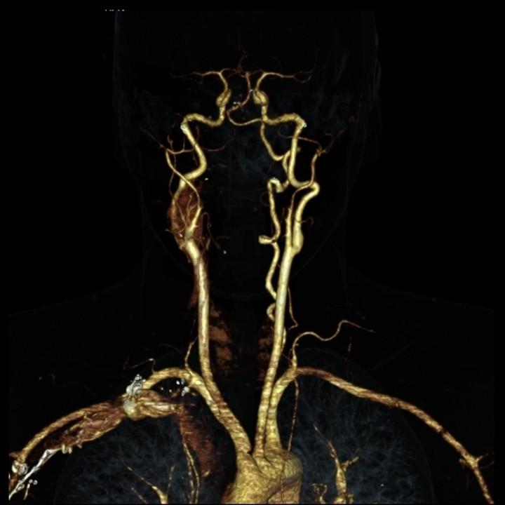 CT angiografie