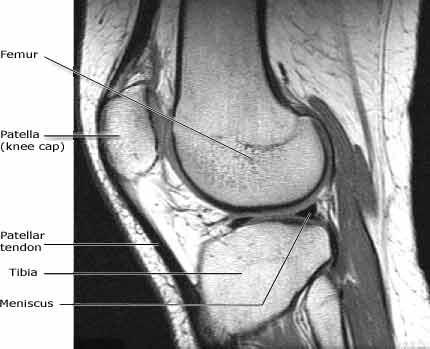 MRI