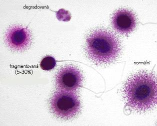 Test integrity DNA spermií Množství dostupných metod SCD, SCSA, TUNEL, Vizualizace zlomů v DNA Při oplození vajíčka spermií s poškozenou DNA může dojít k zastavení vývoje embrya nebo ke