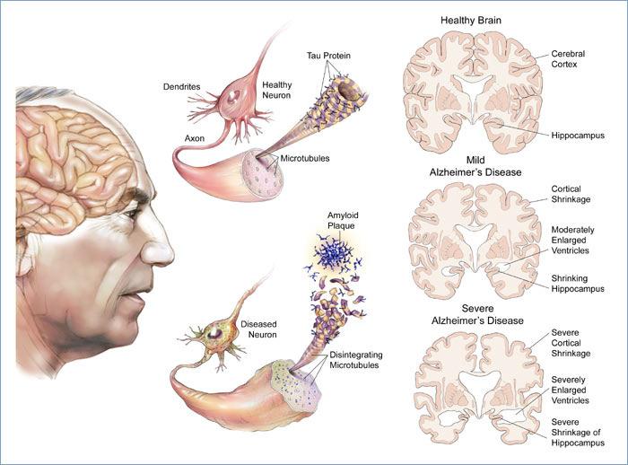 AD is the most common type of dementia which accounts for an estimated 60 80% of all dementia cases.