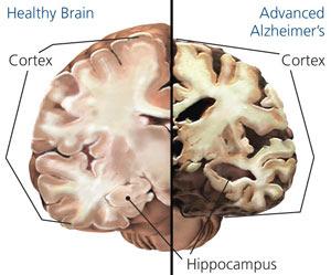 Later symptoms include impaired judgement, disorientation, confusion, behavioral changes, difficulty in speaking, swallowing and walking [6]. Figure 1.1: Alzheimer s Disesase pathology.