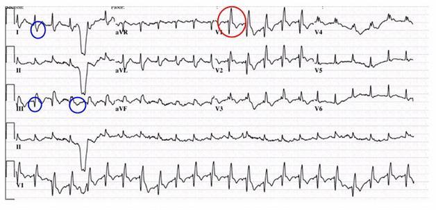 Plicní embolie Dg: Klinický obraz Bedside ECHO D shape LK, dilatace PK, a/hypokineze volné stěny PK, Tri regurgitace (obstrukce 30%