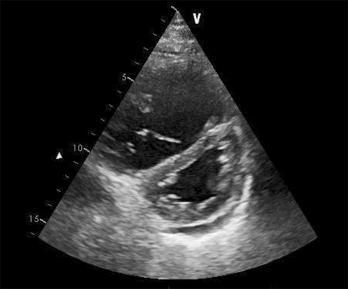 pulmonalis) EKG: S1 Q3 T3, neg T V1-4, IRBBB Nízké etco2 i přes velmi kvalitní KPR D-dimery CT angiografe plicnice, scinty, MRI (nelze