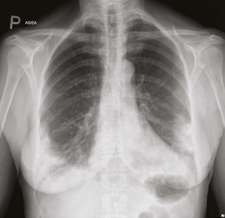 a více specifických laboratorních i zobrazovacích metod. Diagnostika polékového postižení plic je poměrně složitá.