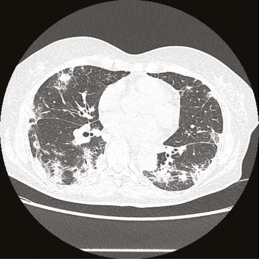 atypickými patogeny (Mycoplasma pneumoniae, Chlamydophila pneumonie nebo Legionella), mykobakteriemi nebo plísňovými organismy.